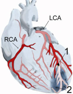 A Myocardial Infarction